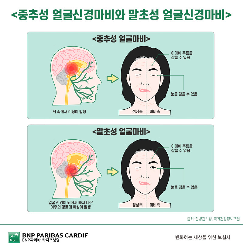 중추성 얼굴신경마비와 말초성 얼굴신경마비